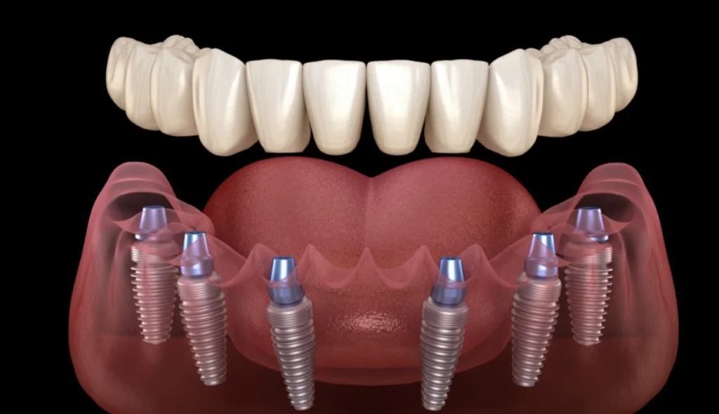 Confidence Restored Your Tech-Driven Path to a Smarter, Faster All-Teeth-On-4 Recovery