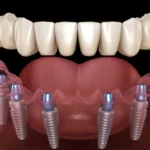 Confidence Restored Your Tech-Driven Path to a Smarter, Faster All-Teeth-On-4 Recovery